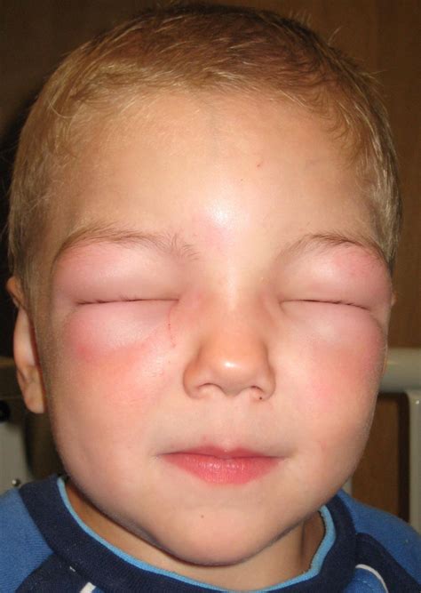 Allergic Reactions - Urgent Care Clinic Pflugerville