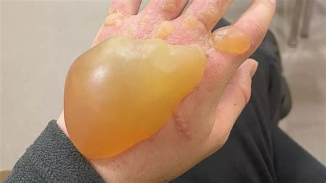 Teen left with blister as big as an ORANGE after touching 'UK's most ...