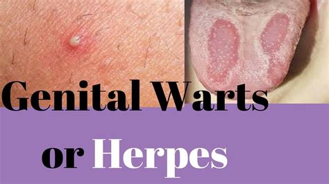 Genital Warts Or Herpes - Similarities And Differences Of Genital Warts ...