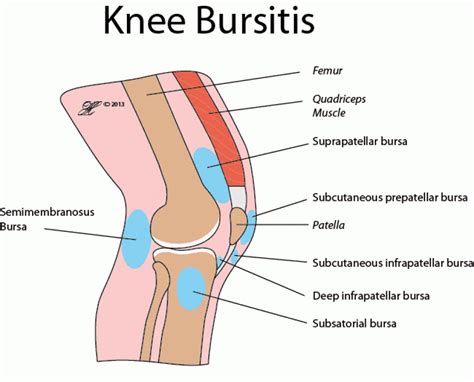 Knee bursitis