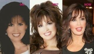 Marie Osmond Plastic Surgery Botox Injections Before and A… | Flickr