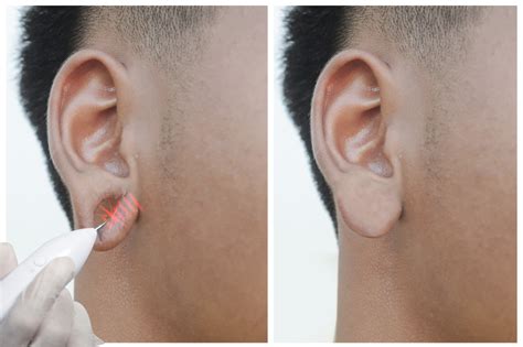 Ear Lobe Repair - Peel Haus | Aesthetics & Plastic Surgery DC