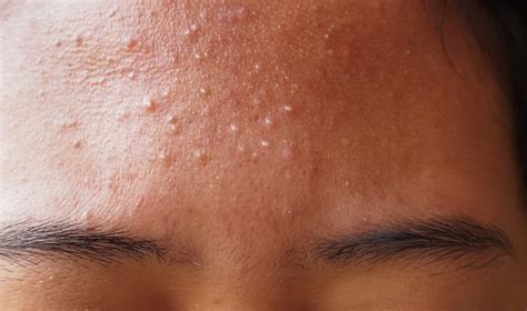 What does fungal acne look like? - The Wiire