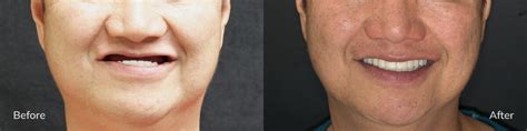 Zygomatic Implants | Inland Empire OMFS