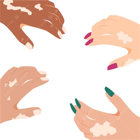 Illustration Of Four Hands Suffering From Vitiligo With Varying Skin ...