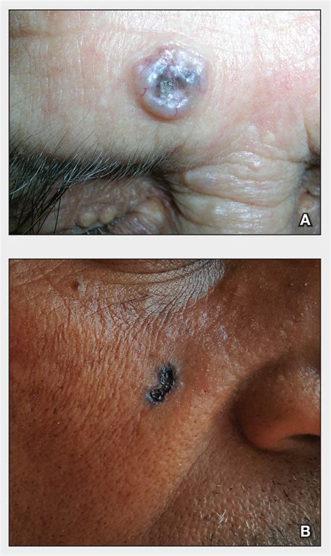 Basal Cell Carcinoma | MDedge Dermatology