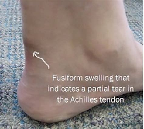 Achilles Tendon Ruptures | Causes and treatment options | MyFootShop.com