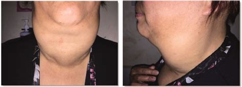 The patient had a large, wide-ranging diffuse goiter in the neck that... | Download Scientific ...