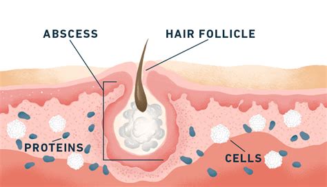 HS Symptoms & Pictures | No BS About HS