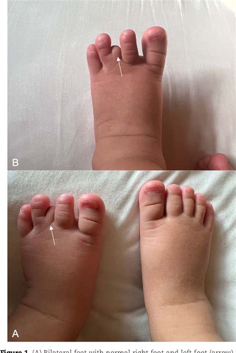 Figure 1 from Brachydactyly type B: a rare case report and literature ...