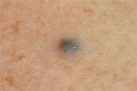 What is Blue Rubber Bleb Nevus Syndrome?