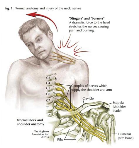 Brachial Plexus: Traumatic Nerve Injuries - Hughston Clinic