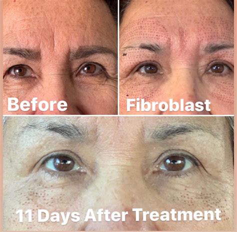 Fibroblast Plasma Skin Tightening Treatment North Carolina — Izar Wellness Institute