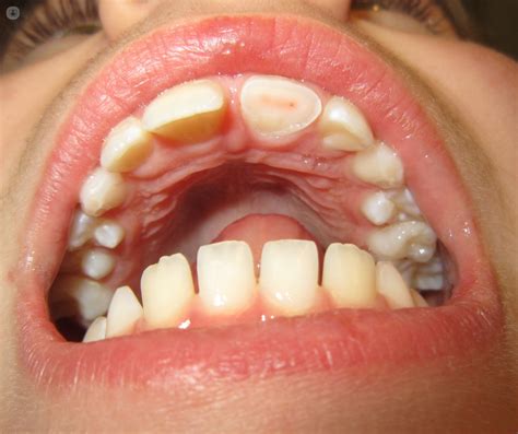 Dental trauma: what is it and how is it treated? | Top Doctors