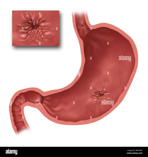 Duodenal wall Cut Out Stock Images & Pictures - Alamy