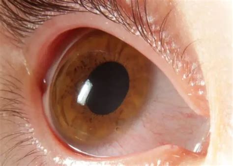 Corneal and Scleral Diseases - Sreedhareeyam Ernakulam