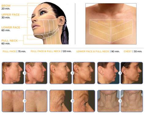 HIFU Treatment | Face & Neck Lift | Prime Aesthetica