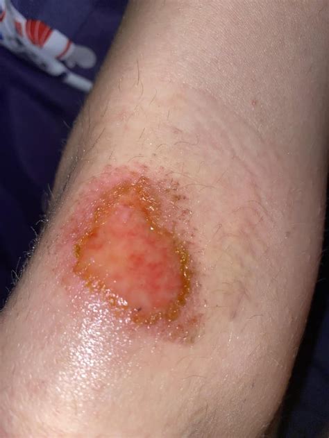 Is my Scraped knee infected or just healing? : r/firstaid