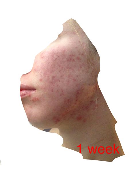 Accutane update w/ pictures! 3 weeks – Prescription acne medications ...