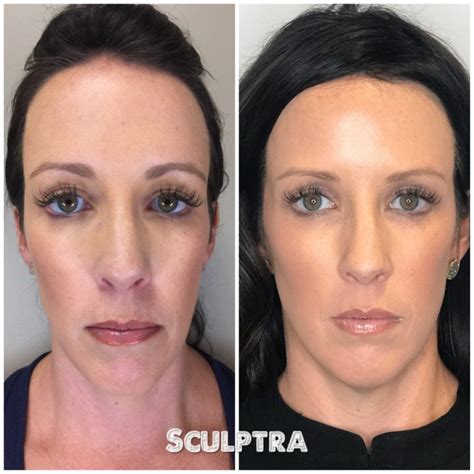 Sculptra Aesthetic Injections in Gilbert AZ | Colair Med Spa