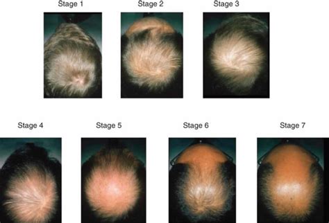 Male or female pattern baldness causes and baldness treament