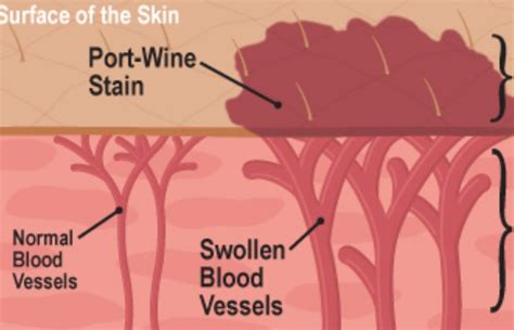 Port wine stain Help - Ask for Advice - Sapien Medicine