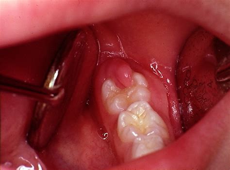 Pericoronitis - Pictures, Treatment, Symptoms, Causes