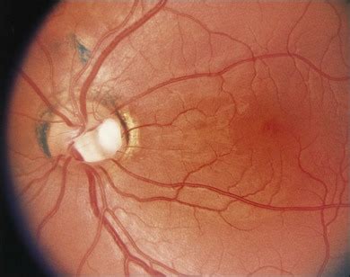 Optic Disc Anomalies, Pits, and Associated Serous Macular Detachment | Clinical Gate