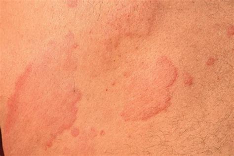 Hives vs. Rash: What Are the Differences?