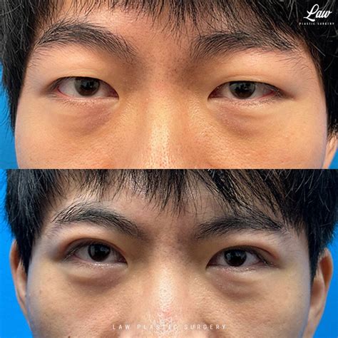 Asian Eyelid Surgery Before & After Photos - Law Plastic Surgery