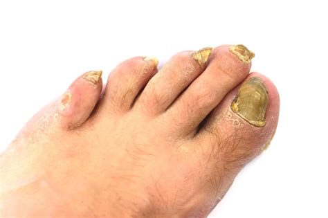 9 Natural Ways to Treat Toenail Fungus at Home – Onychomycosis Help