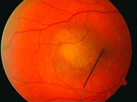 Color fundus photograph of the right eye of the patient. | Download ...