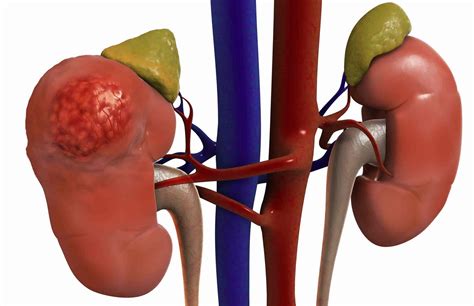 Scientists discover new condition that causes liver, kidney failure
