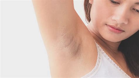 Get Treatments for Dark Underarms | Belo Medical Group