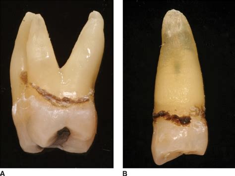 The influence of tooth anatomy on periodontal instrumentation, oral hygiene instruction, and ...