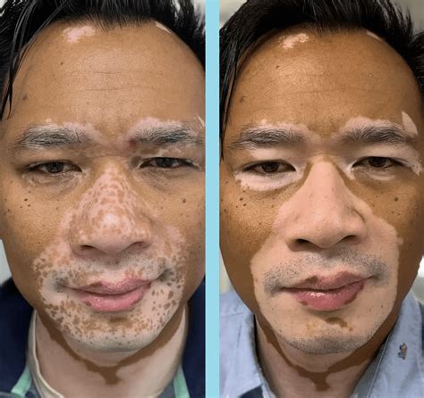 Opzelura For Vitiligo: Before And After Pics & Reviews - Dibesity