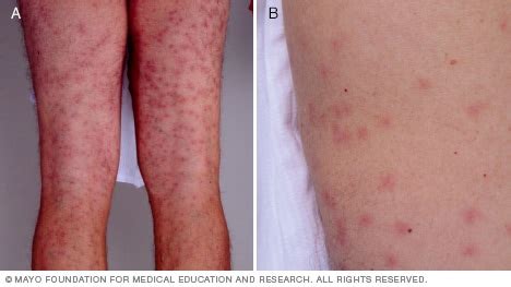 Presentación de diapositivas: sarpullidos comunes - Mayo Clinic