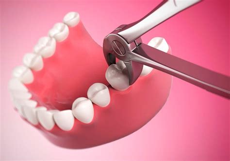 Tooth Extraction Pain: How Long Does It Take To Go Away? Anoka Dental