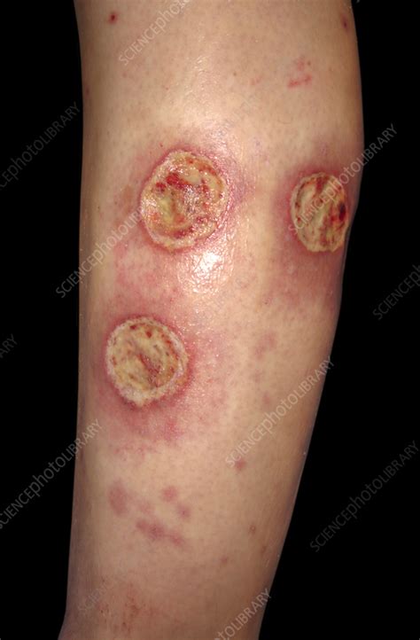 Ecthyma gangrenosum on a woman's leg - Stock Image - C058/5968 ...