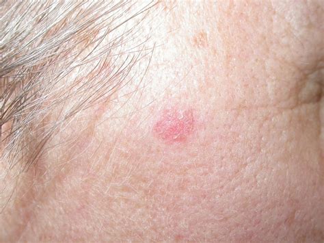 Basal Cell Carcinoma Chest at Buford Wood blog