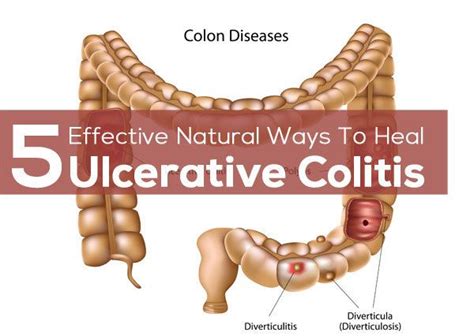 Ulcerative Colitis Diet – Foods To Eat And Avoid With Diet Chart | Ulcerative colitis diet ...