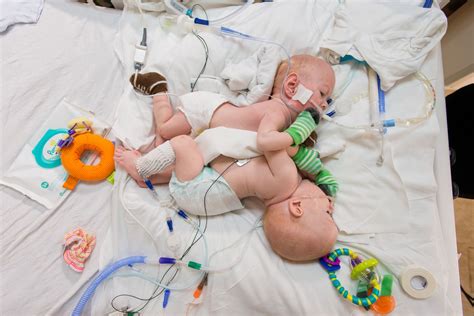 5 Amazing Stories of Conjoined Twins That Were Successfully Separated - RateMDs Health News