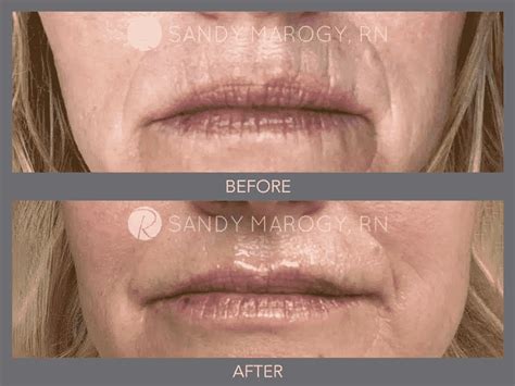 Filler Lips Smokers Lines | Lipstutorial.org