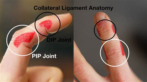 Collateral Ligament Injury from Rock Climbing (Causes & Fix) — Hooper's Beta