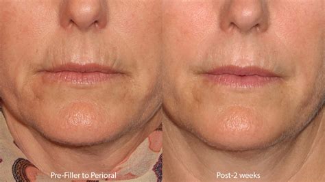 Lip Lines San Diego, CA | Cosmetic Laser Dermatology