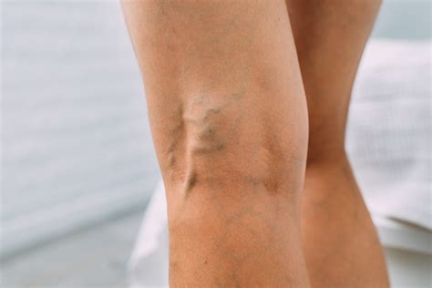 What Causes Veins to Show in Legs? - The Vein Center of Maryland