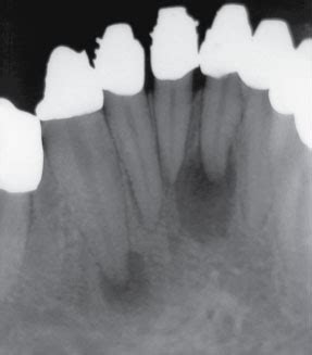 Granuloma Periapical; Granuloma Dentário; Periodondite Periapical não Supurativa Crônica ...