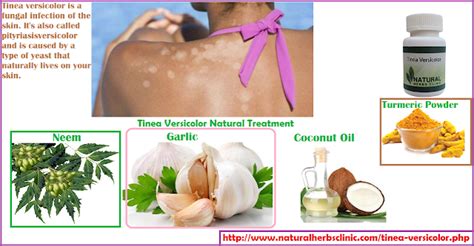 Tinea Versicolor Natural Treatment