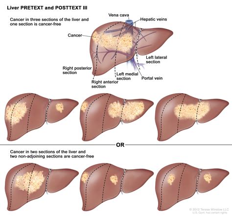 Childhood Liver Cancer Treatment (PDQ®) - NCI