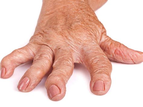 Rheumatoid arthritis knees symptoms